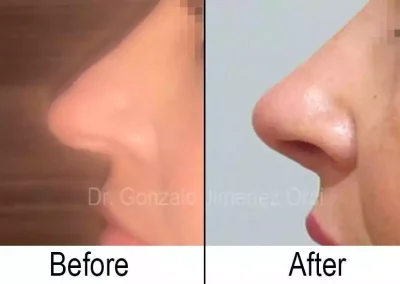 Rinoplastia, cirugía de nariz, clientes satisfechos Dr. Gonzalo Jiménez Orci