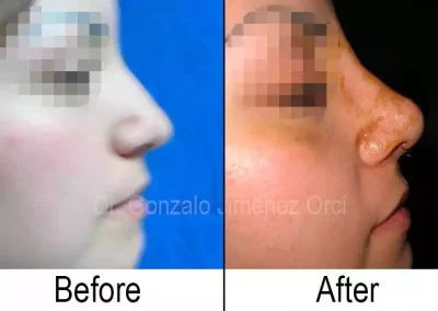 Rinoplastia, cirugía de nariz, clientes satisfechos Dr. Gonzalo Jiménez Orci
