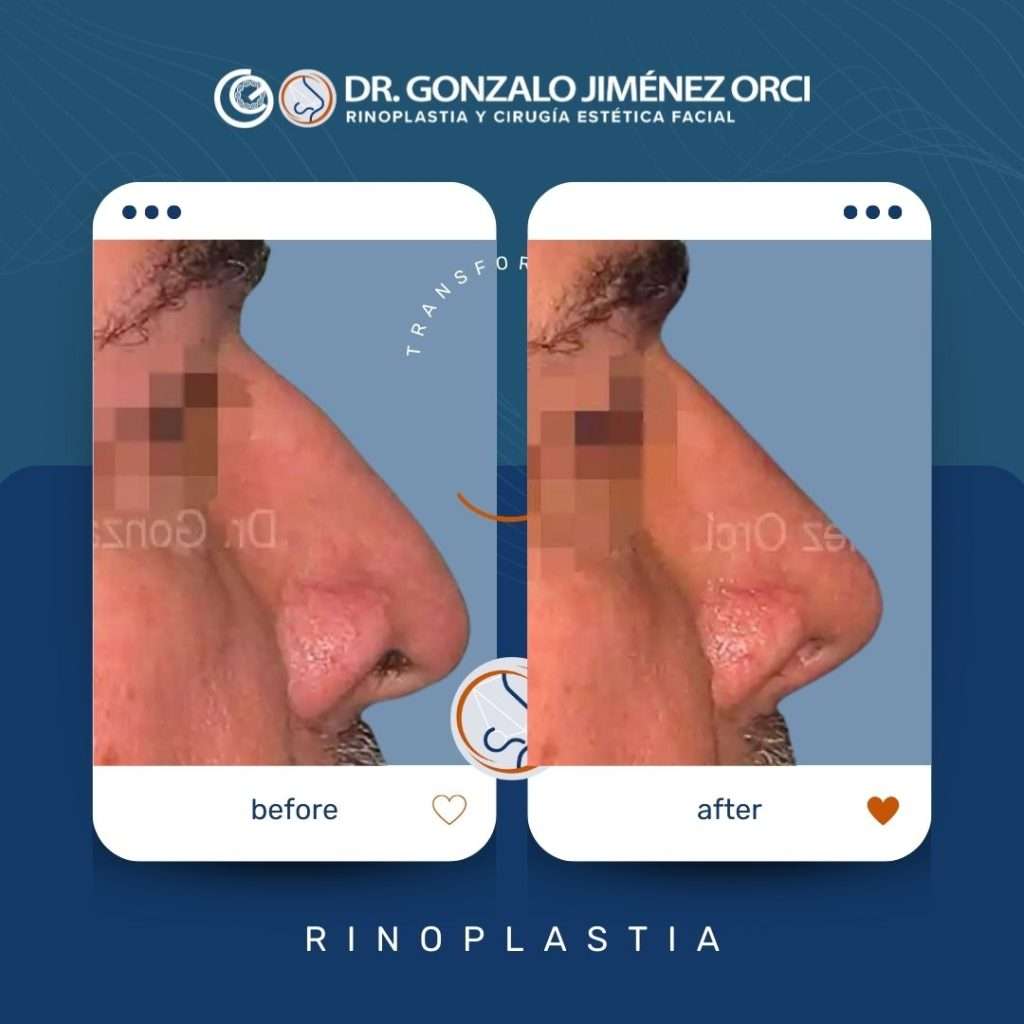 Rinoplastia por Dr Gonzalo Jimenez Orci