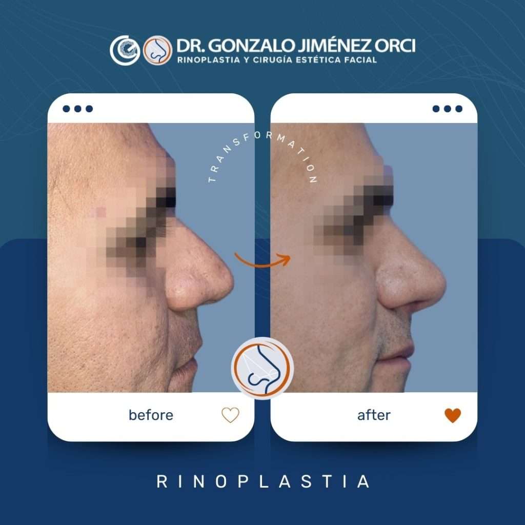 Rinoplastia por Dr Gonzalo Jimenez Orci